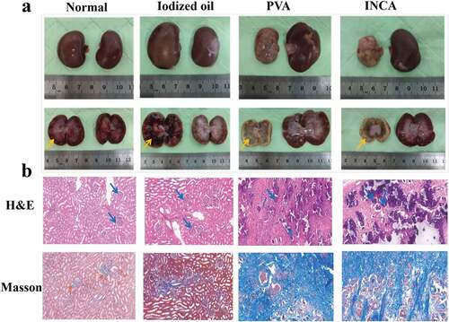 Figure 6. Histopathological evaluation of embolization effect. (a) the Normal physiological, iodized oil, PVA, and the INCA nanogels groups kidney tissue image of 42 days. (b) H&E and Masson staining of the Normal, iodized oil, PVA, and the INCA nanogels groups (original magnification, ×200).