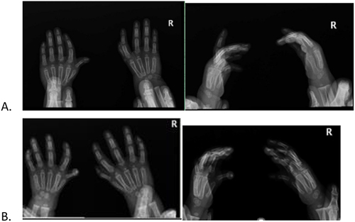 Figure 2 Ap and lateral X-ray of bilateral hands of the children: (A) Twin A; (B) Twin B.