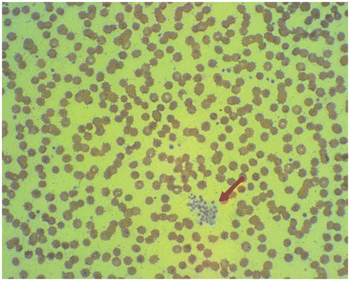 Figure 1. The presence of platelet clumping on peripheral blood smear (red arrow).