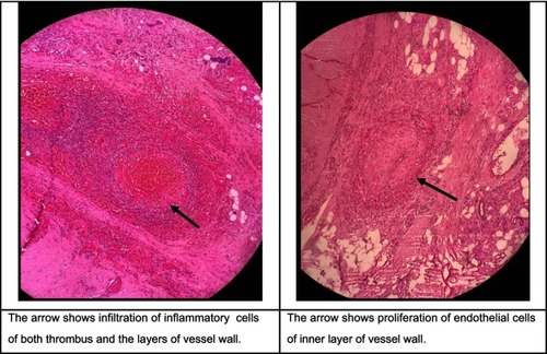 Figure 3 H&E staining; ×10 objective lens. The biopsy obtained around the ulcer of the amputated limb of a patient with diagnosis of Buerger’s disease