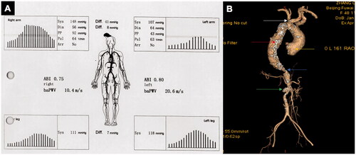 Figure 2. A 48-year-old female TA patient with many arteries involved had six abnormal investigated parameters of 4LBP and baPWV measurements. A: Boso 4LBP and baPWV measurements with the IASBPD > 15 mmHg, ILSBPD > 15 mmHg, bilateral ABI < 0.9, PP > 70 mmHg, PI > 1.0, and ΔbaPWV > 185 cm/s. B: CTA showed severe stenosis of the proximal left subclavian artery (white arrow), aneurysmal dilatation of aortic root (yellow arrow), thoracic aortic dilatation with wall calcification (red arrow), severe stenosis of the proximal abdominal aorta (blue arrow), occlusion of left renal artery (green arrow). TA: Takayasu arteritis; 4LBP: four-limb blood pressure; baPWV: brachial–ankle pulse wave velocity; IASBPD: inter-arm systolic blood pressure difference; ILSBPD: inter-leg systolic blood pressure difference; ABI: ankle-brachial index; PP: pulse pressure; PI: pulsatile index; ΔbaPWV: inter-side baPWV difference; CTA: computed tomography angiography.