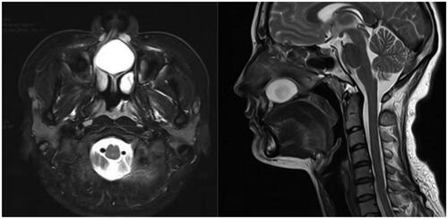 Figure 3. MRI shows a cyst in the palate.