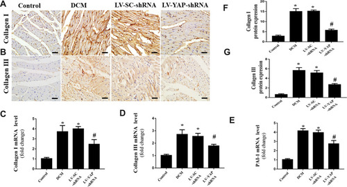 Figure 3 Collagen expression in the myocardium in vivo (n=6). (A and B) Representative immunohistochemical staining of collagen I and collagen III in the 4 groups (scale bar=20 μm). (C–E) Collagen I, collagen III and PAI-1 mRNA expression in the 4 groups. (F and G) Quantitative analysis of collagen I and collagen III protein expression shown in (A) and (B). *P<0.01 versus the control group; #P<0.01 versus the LV-SC-shRNA group.