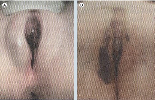 Figure 2. Straddle injury.(A) Straddle injury in 6-year-old who fell while climbing over a chair sustaining a stable periclitoral hematoma. (B) Same patient 6 days later with extravasation of hematoma.Reprinted with permission from Diane Merritt, Washington University, St Louis, MO, USA.