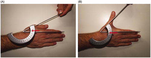 Figure 4. For intermetacarpal angle, the goniometer was aligned with the first and second metacarpal heads for evaluating radial adduction (A) and radial abduction (B) (red arrow).