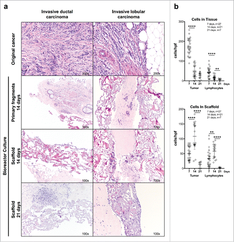 Figure 2. Culture of breast cancer fragments in perfused bioreactors: preservation of TME cellular components. (A) Fragments from two representative surgically excised breast cancer specimens were inserted between collagen type I scaffolds and cultured in perfused bioreactors for the indicated time. Samples were then collected, fixed, and paraffin embedded. HE-stained sections from the original surgical specimens, cultured fragments and infiltrated scaffolds were then comparatively evaluated (Magnification 100× or 200× as indicated). (B) Quantitative analysis of tumor cell and lymphocyte numbers within cultured tumor fragments and collagen scaffolds at the indicated time points. Displayed results summarize data from 27 different breast cancer specimens. In one cultured specimen, the initial tissue fragment did not contain cancer, and in two additional specimens, counting of tumor cells and lymphocytes could not be performed due to lack of material, and thus these specimens were omitted for data analysis. Non-parametric Mann–Whitney test (****p ≤ 0.0001).