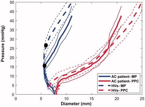 Figure 4. Pressure-diameter relationship of the anal canal. The averaged diameter and pressure relationship of the middle and proximal part of the anal canal during inflation up to 50ml is shown for patients treated for anal cancer (AC, heavy solid lines) and for healthy volunteers (HVs, heavy dotted lines). The middle part of the anal canal is less distensible than the proximal part. The curves from AC patients are located to the right of the corresponding curves from healthy controls, indicating a softer wall in patients. The two black markers indicate the yield pressure needed for opening of the middle part of the anal canal. The light solid and dotted lines are the 95 percent confidence intervals.