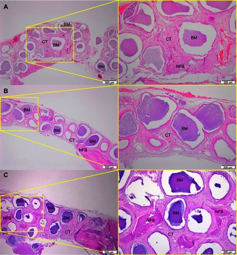 Figure 6 Micrographs of Zn-cHA group after 1 (A), 3 (B) and 6 (C) months of implantation, respectively.Notes: Magnification: 10X. The squares indicate the magnified area observed using a 40X objective. BM, Biomaterial; NFB, New Formed Bone; CT, Connective Tissue. Stain: HE.Abbreviations: Zn-cHA, Zinc-doped carbonated hydroxyapatite; HE, hematoxylin-eosin.