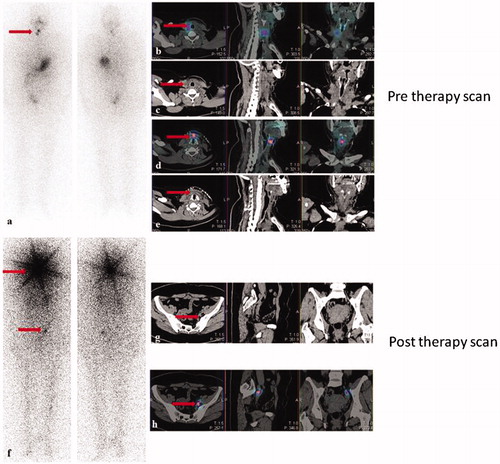 Figure 4. Pre- and post-operative scans following radioactive iodine ablation.