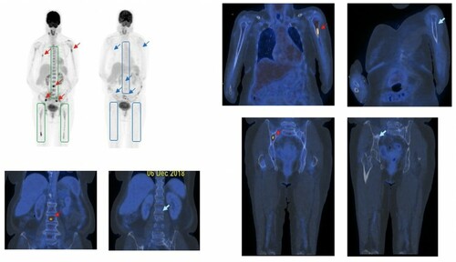 Figure 2. PET-ve CR based on the complete resolution of (i) diffuse hypermetabolic bone marrow lesions in the axial skeleton and both femurs (boxed), and (ii) focal hypermetabolic marrow lesions (red arrows) in the lumbar spine, L humerus and R iliac bone, at the time of serological CR (blue arrows).