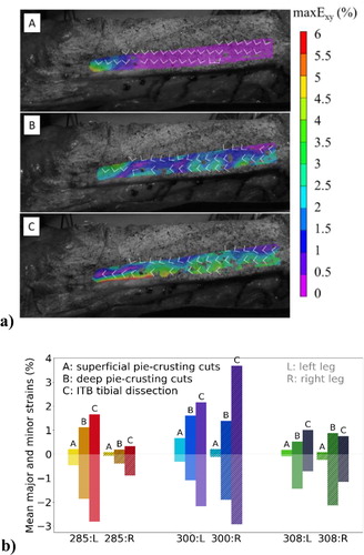 Figure 2. Results representation: a) Maximal shear strain distribution maxExy on the ITB for subject 285, after (A) superficial pie-crusting cuts, (B) deep cuts, and (C) tibial dissection. White arrows show the direction of the major E1 and minor E2 principal strains; b) Average major (positive values) and minor (negative values) principal strain releases measured on the ITB for all subjects.