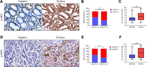 Figure 4 Immunohistochemistry of p-AKT and p-S6K1 correlated with GLUT1 expression in GC tissues. Expression of (A) p-AKT and (D) p-S6K1 were evaluated in gastric cancer (GC) tissues by immunohistochemistry (IHC) (scale bar=100μm). Expression analysis of (C) p-AKT and (F) p-S6K in normal and GC tissues. Proportion analysis of (B) p-AKT (-)/p-AKT (+), (E) p-S6K1 (-)/p-S6K1 (+) in GLUT1 (-)/(+) tissues. (**, P<0.01; ***, P<0.001; —, negative; +, positive).