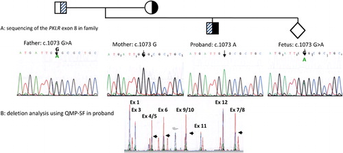 Figure 1. Genetic analysis of proband, parents and prenatal sample. (A) PCR-sequencing of exon 8 shows that the father is heterozygous for the PKLR: c.1073G>A mutation. Mother is hemizygous for normal exon 8 sequence, while the proband is hemizygous for the PKLR: c.1073G>A mutation. The fetus is heterozygous for the PKLR: c.1073G>A mutation. (B) Detection of the c.283+1914_c.1434del5006 deletion. A semi-quantitative PCR is performed with eight sets of primers which cover the whole PKLR gene. A fragment located outside of chromosome 1 is used as internal control for normalization. Chromatogram of a normal sample (red) is superimposed on that of the test sample (blue). Comparison of peak heights between test and normal demonstrates a deletion removing exon 4 to exon 10 in the proband (black arrows).