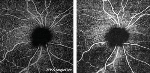 Figure 1 En face images (6×6 mm2) of the radial peripapillary capillaries of the optic nerve head, acquired by automatic (left) and semi-automatic (right) segmentation.