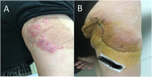 Figure 1 (A) A well-defined semicircular red plaque surrounded by a large pigmented patch is present on the lateral aspect of the right upper arm. (B) Day 10 after surgical removal of skin lesions.