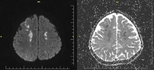 Figure 3 DWI and ADC MRI: Lesions showing acute diffusion restriction were detected in both parietal, frontal and right occipital lobes (acute/subacute ischemic infarct).