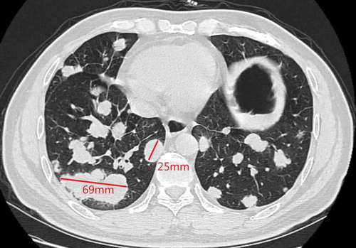Figure 1. Chest computed tomography (CT) in Nov 2018 (before fruquintinib)