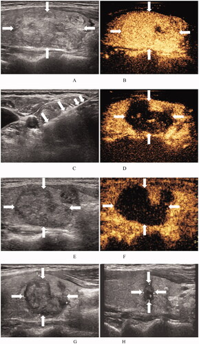 Figure 2. Ultrasound images of a 48-year-old woman with a BTN before and after RFA. (A) Before RFA, an ultrasound image reveals a solid mixed echo nodule (arrows), with a nodule volume of 7.06 mL. (B) Before RFA, the nodule shows hyper-enhancement (arrows) on a CEUS image of the early phase. (C) Ultrasound image shows insertion of the needle (short arrows) into the nodule and appearance of a hyperechoic ablation zone during RFA (long arrows). (D). Immediately after RFA, the ablation zone (arrows) shows no enhancement on CEUS images. (E) At 1 month after RFA, the volume of the ablation zone (arrows) is 4.01 mL (VRR = 43.2%). (F) At 1 month after RFA, the ablation zone (arrows) shows no enhancement on CEUS images. (G) At 3 months after RFA, an ultrasound image reveals that the volume of the ablation zone (arrows) has decreased to 2.15 mL (VRR = 69.5%). (H) At 12 months after RFA, the volume of the ablation zone (arrows) has decreased to 0.12 mL (VRR = 98.3%). BTN: benign thyroid nodule; RFA: radiofrequency ablation; VRR: volume reduction ratio; CEUS: contrast-enhanced ultrasound.