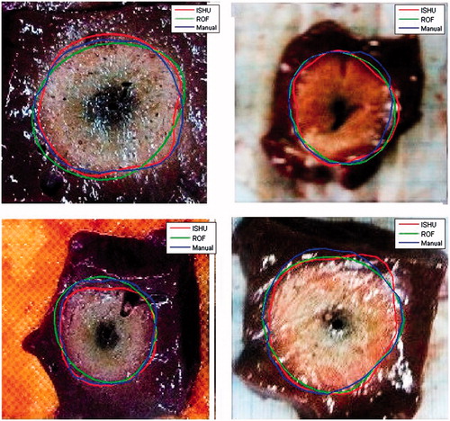 Figure 8. Exemplary results obtained by both algorithms and the corresponding average manual contours depicted atop the gross pathology images. All images are 55 × 55 mm in size.