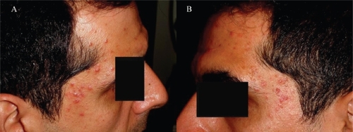 Figure 2 The maculopapular rash on the patient’s temporal regions around his eyes: right (A) and left (B).