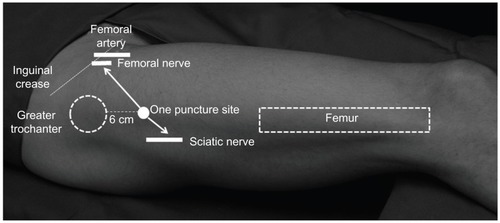 Figure 1 Diagram for insertion of the needle.