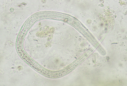 Figure 3 Microscopic examination of sputum shows Strongyloides stercoralis. Original magnification ×400.