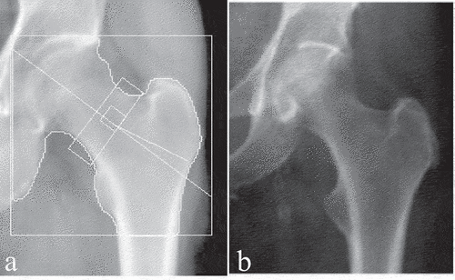 Figure 1. Standard clinical hip DXA images. (a) hip DXA image from the CLSA, with the white boundary lines (b) hip DXA image from the CaMos, with no white boundary lines.