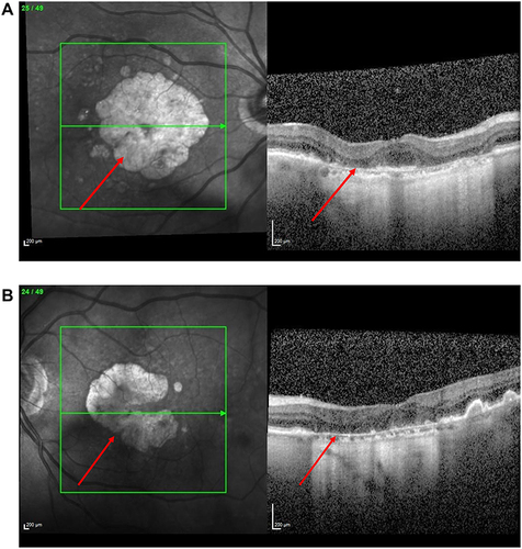 Figure 1 (A) Image of Right Eye using Heidelberg Spectralis. Near infrared shows geographic atrophy lesion with foveal island spared. Bscan shows loss of RPE and photoreceptor layer with hypertransmission consistent with geographic atrophy. (B) Image of Left Eye using Heidelberg Spectralis. Near infrared shows geographic atrophy lesion which has encroached on the fovea. Bscan similar findings to (A).