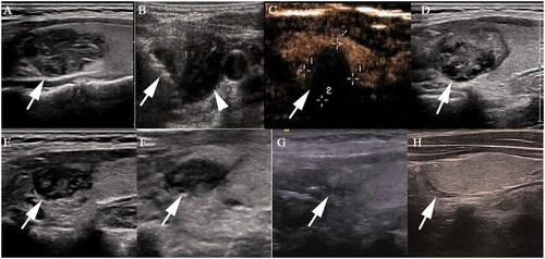 Figure 4. Radiofrequency ablation (RFA) treatment and follow-up of a 29-year old woman with T2 papillary thyroid carcinoma. (A) A heterogeneously hypoechoic nodule with an irregular margin, size 2.4 × 1.3 × 1.4 cm, was detected in the upper part of left thyroid lobe (white arrow). (B) The nodule was covered by a hyperechoic area (white arrow) on ultrasonography during the RFA procedure, and hydrodissection (arrow head) was used to protect the vital organs from thermal injury. (C) Contrast-enhanced ultrasonography immediately after RFA showed non-enhancement in the ablation zone. (D–G) The ablation area decreased gradually to 2.0 × 1.1 × 1.3 cm, 1.3 × 0.7 × 0.8 cm, 0.9 × 0.6 × 0.8 cm and 0.5 × 0.2 × 0.4 cm 1, 3, 6 and 12 months, respectively, after ablation. (H) Ultrasonography 18 months after ablation showed a needle track.