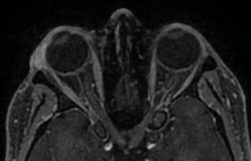Figure 3 Right lacrimal gland enlargement with subtle enlargement of the right medial rectus muscle sparing the tendinous insertion in Thyroid Related Orbitopathy (TRO).