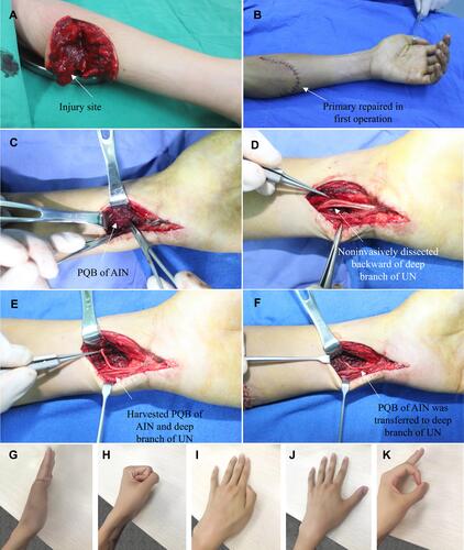 Figure 4 Typical case 3 in group I a 19-year-old male presented with a knife cut in the left proximal forearm. Direct fascicular suture was performed in the injured site of the ulnar nerve. Transfer of the pronator quadratus muscle nerve branch to the ulnar nerve deep branch was performed in the wrist. (A) An open wound and complete division of the ulnar nerve were observed in the proximal forearm; (B) Emergency debridement, hemostasis, and closure of the wound were performed; (C) The anterior interosseous nerve branch of the pronator quadratus muscle was exposed in the wrist incision; (D) The deep and superficial branches of the ulnar nerve were exposed in the wrist incision; (E) The anterior interosseous nerve branch of the pronator quadratus muscle was divided at the farthest end, and the deep branch of the ulnar nerve was separated non-invasively and then divided at the proximal end; (F) Transfer of the pronator quadratus muscle nerve branch to the ulnar nerve deep branch was performed using end-to-end anastomosis; (G–K) Follow-up after surgery: (G, H) Finger flexion and extension movements were normal; (I, J) The function of the intrinsic muscles of the hand was tested by abduction and adduction motions; (K) Negative Froment’s sign.Abbreviations: UN, ulnar nerve; AIN, anterior interosseous nerve; PQB, pronator quadratus branch.