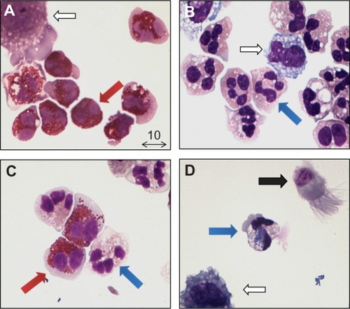Figure 2 Inflammatory phenotypes of adult asthma patients obtained by sputum induction. (A) Eosinophilic type; marked by the presence of eosinophils ≥3% (red arrow). The hollow arrow indicates an alveolar macrophage. (B) Neutrophilic type; marked by the presence of neutrophils (blue arrow) ≥61%. The hollow arrow indicates an alveolar macrophage. (C) Mixed type; marked by the presence of both eosinophils (red arrow) ≥3% and neutrophils (blue arrow) ≥61%. (D) Paucigranulocytic type; marked by a lack of eosinophils (<3%) and neutrophils (<61%). The arrow shows a ciliated pseudostratified columnar airway epithelial cell (black arrow), a neutrophil with phagocytosed bacteria inside (blue arrow) and an alveolar macrophage (hollow arrow). May-Grünwald/Giemsa staining, photograph at 100× magnification, courtesy of Dr JAM van der Linden (UMC Utrecht, The Netherlands).