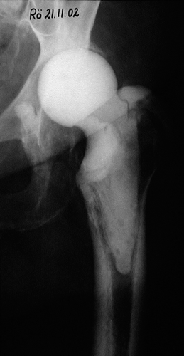 Figure 7. Articulating hip spacer fixed according to the “glove technique” in situ.