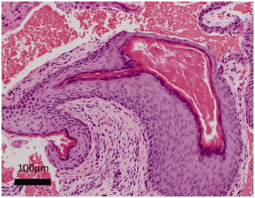 Figure 2. Keratin debris and keratinized epithelium, compatible with cholesteatoma diagnosis.