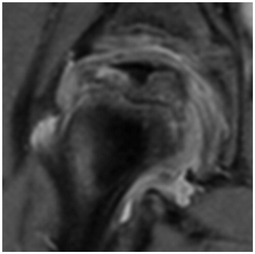 Figure 4. At 11.5 months. PD-weighted MRI. Beginning of loss of containment. Stage IIb.