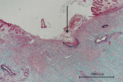 Figure 1. Photomicrograph of case 1. Elastica-Masson staining shows a ruptured arteriole (arrow) with a mucosal defect, measuring up to 2 mm in diameter.