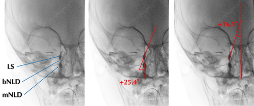 Figure 4 Methods for measuring the frontal LS–NLD angle and LS–midline angle.The measurements denoted angles by positive values to signify medial inclination and negative values to represent lateral inclination. From left to right: the sequence displays the original image, the measurement of the frontal LS–NLD angle, and the measurement of the LS–midline angle. The images were converted to monochrome to enhance the contrast media visibility.