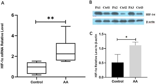 Figure 2. HIF-1α expression increased in patients with AA. (A) Relative HIF-1α mRNA levels in AA patients were higher than those in the controls (P < 0.01). (B) HIF-1α protein expression for three patients with AA increased relative to that of controls. (C) HIF-1α protein levels relative to β-actin were higher than in AA patients than those of healthy controls (P < 0.05).