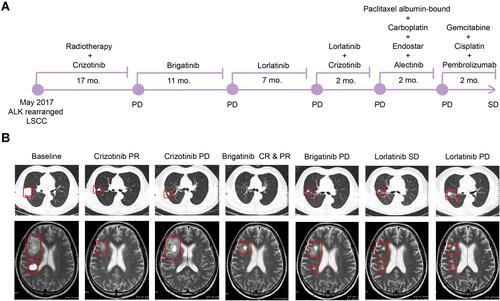 Figure 1 Medication strategy and disease conditions of the patient during treatment. (A) An illustrated summary of the treatment received by the patient. (B) Thoracic CT images of primary lung lesions and MRI images of brain metastatic lesions during sequential ALK-TKI treatment. Tumors are indicated by red frames.