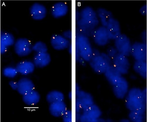 Figure 1 Examples of FISH findings using the 3p13 deletion probe.Notes: (A) Normal 3p13 copy numbers as indicated by two green 3p13 signals and two orange centromere 3 signals. (B) Heterozygous deletion as indicated by the lack of one green 3p13 signal and two orange centromere 3 signals. Magnification 630×.Abbreviation: FISH, fluorescence in situ hybridization.