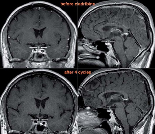 Figure 3. T1 weighted MRI scans of the brain in coronary (left) and sagittal (right) planes after application of contrast agent in Case 3. The ball-shaped enlargement (infiltration of the hypophysis infundibulum by LCH) fully retreated after cladribine monotherapy.