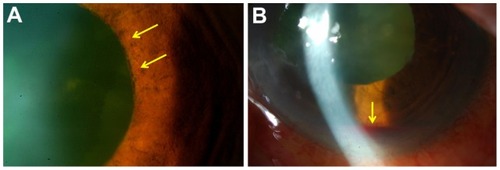 Figure 3 (A) Slit-lamp photograph showing iris rubeosis (arrows) at circumferential pupil margin. (B) There is an obvious hyphema (arrow) in the left eye.