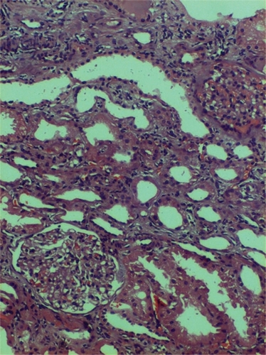 Figure 2 Glomeruli showed moderate mesangial matrix accentuation with hypercellularity. Capillary lumina were open with thickened, wrinkled membranes. Bowman’s capillary segmentally thickened and occasionally ruptured. Tubules had moderate degenerative changes. Mild interstitial edema with diffuse mixed leucocytic infiltration noted.