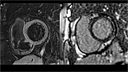 Figure 4 Cardiac MRI images in a 45-year-old female patient with Long-COVID-19 myocarditis, at 5 weeks after discharge from hospital: (A) fat saturated T2- weighted image in short axis view at basal left ventricle (LV) shows normal myocardial signal intensity, suggesting absence of edema. (B) Late gadolinium enhancement (LGE) PSIR sequence in short axis view done at 15 minutes post contrast shows presence of linear LGE in anteroseptal segment of the basal LV (white arrows), denoting presence of fibrosis, likely sequel of myocardial injury due to the prior COVID infection.