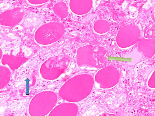 Fig. 3 Necrosis of individual muscle fibers (yellow arrow) with edema (blue arrow) in between fibers characteristic of diabetic myonecrosis.