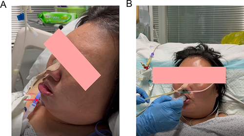 Figure 5 The swallowing function of the patient before and after rehabilitation exercise. (A) Before rehabilitation exercise, the patient developed cough, the red arrow indicates that the patient has swallowing disorders, which leads to the fluid flows out and severe cough when drinking water; (B) After rehabilitation exercise, the phenomenon of bucking disappeared.