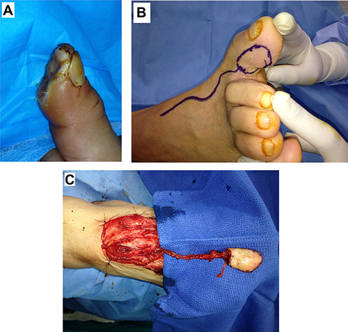 Figure 2 (A) Large skin-soft tissue defect of the pulp of the right thumb, 3.5×2.5cm. (B) The template of the flap and course of the supplying vessels. (C) The flap elevated with vascular pedicle dissected.