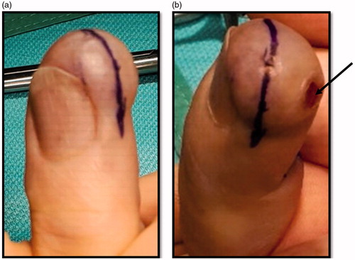 Figure 1. (a,b) Pre-operative images of the distal right middle finger volar surface. Figure b shows the surface ulceration evident at presentation (black arrow).