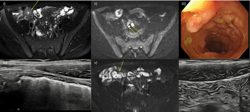 Figure 2. Transmural healing. A 15-year-old male patient with newly diagnosed Crohn’s disease. At baseline, MRE showed moderately active disease involving the terminal and distal ileum (i) axial fat-saturated T2-weighted MRI image showing terminal ileal mural thickening and increased mural T2 signal (arrow), and mesenteric free fluid mainly in the right iliac fossa, ii) corresponding high signal on diffusion weighted images with enlarged reactive mesenteric nodes (arrows). iii) Baseline ileocolonoscopy documented a simple endoscopic score (SES-CD) of 15 iv) after 6 months of infliximab and methotrexate therapy ultrasound fulfilled the criteria for true transmural healing with normal mural thickness (≤3 mm) and stratification, and complete resolution of mesenteric changes. Small bowel motility was subjectively normal. Axial fat-saturated MRE image confirmed transmural healing of the terminal ileum (arrow) was maintained at 12 months (v), and at again at 18 months on IUS (vi). MRI: Magnetic resonance imaging; MRE: MR enterography; IUS: intestinal ultrasound.