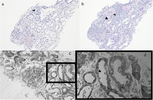 Figure 1 Light microscopy findings (×200). (a) Hematoxylin-eosin and (b) Periodic acid-Schiff-stained specimens show normal glomeruli and tubulointerstitial damage with tubular lymphocytic infiltration. (c and d) Electron microscopy findings. Normal glomeruli and nuclear and vacuolar degeneration in the tubules are observed (white arrows).